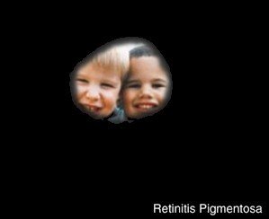 Two boys from the perspective of someone with RP